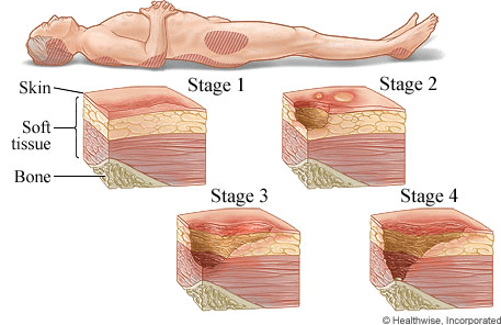 Wound Progression for a Pressure Ulcer - MVS Wound Care & Hyperbarics